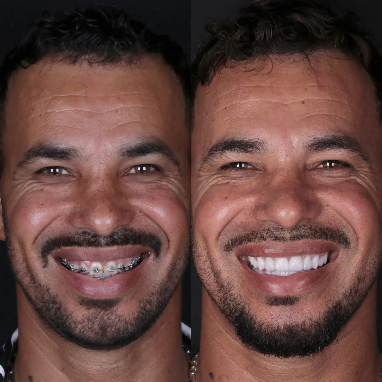 Invisalign