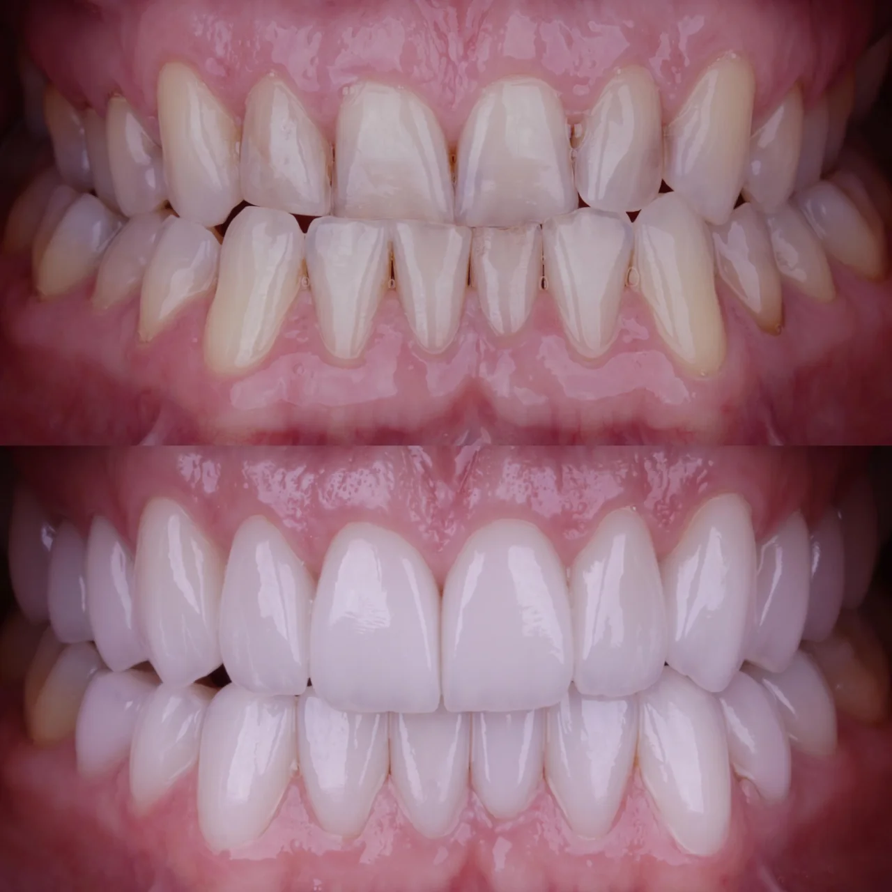 Full-Mouth Rehabilitation