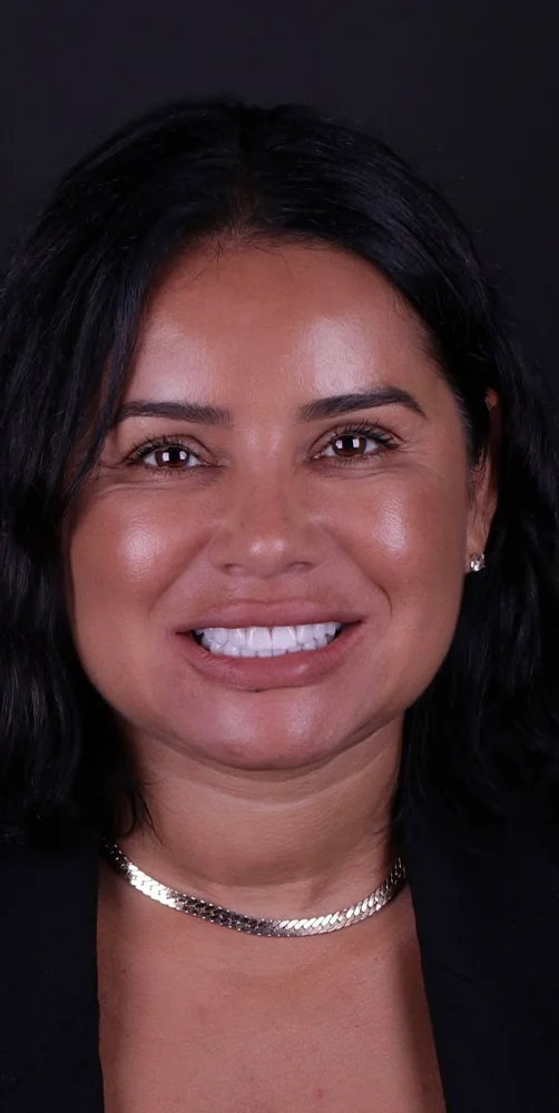 Porcelain veneers with a natural finish