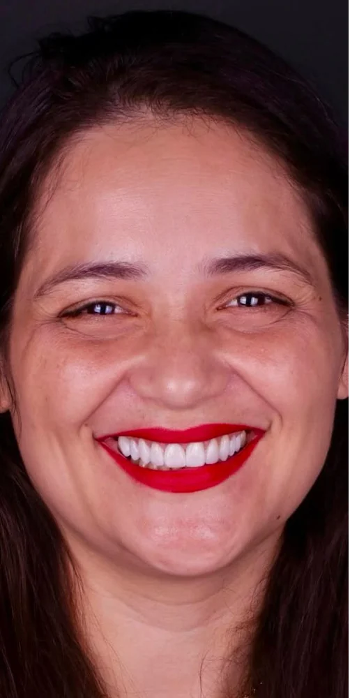 Before and after teeth alignment and whitening