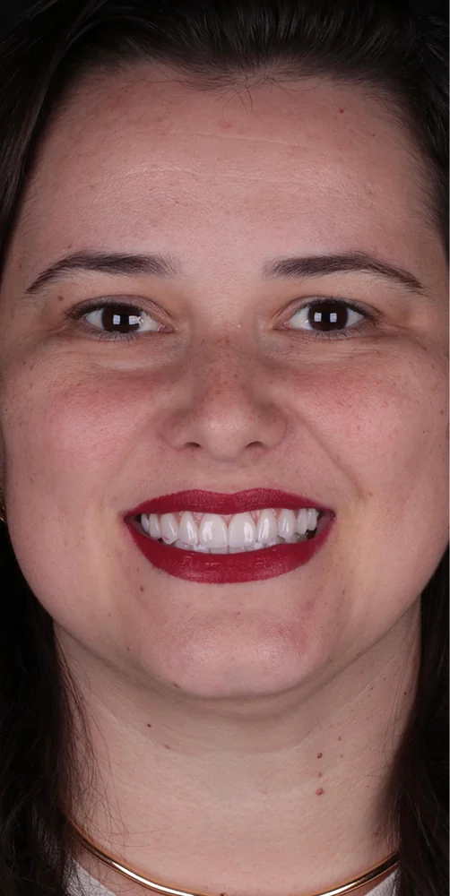 Smile after treatment at IDF Oral Clinic
