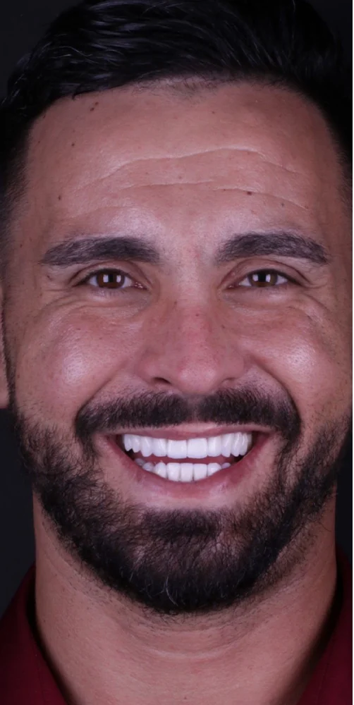 Before and after a dental implant