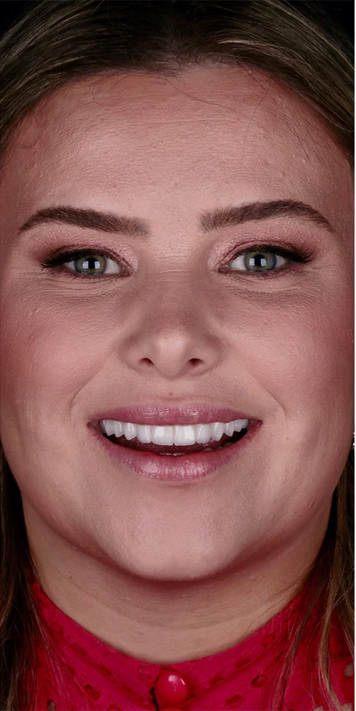 Final smile result with an implant