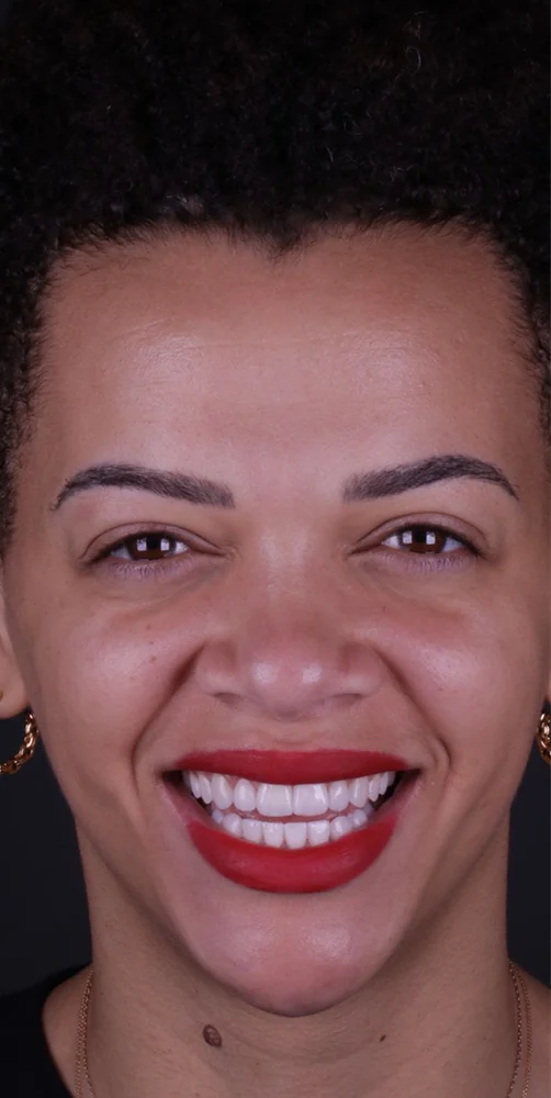 Natural smile after a dental prosthesis