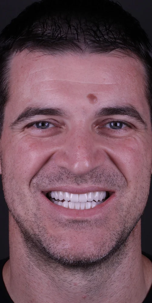 Before and after full-mouth rehabilitation
