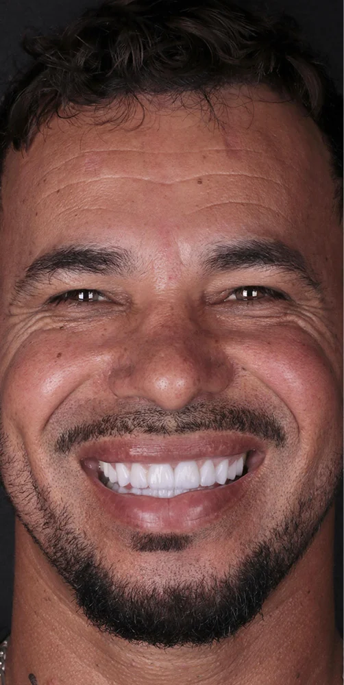 Teeth after complete full-mouth rehabilitation