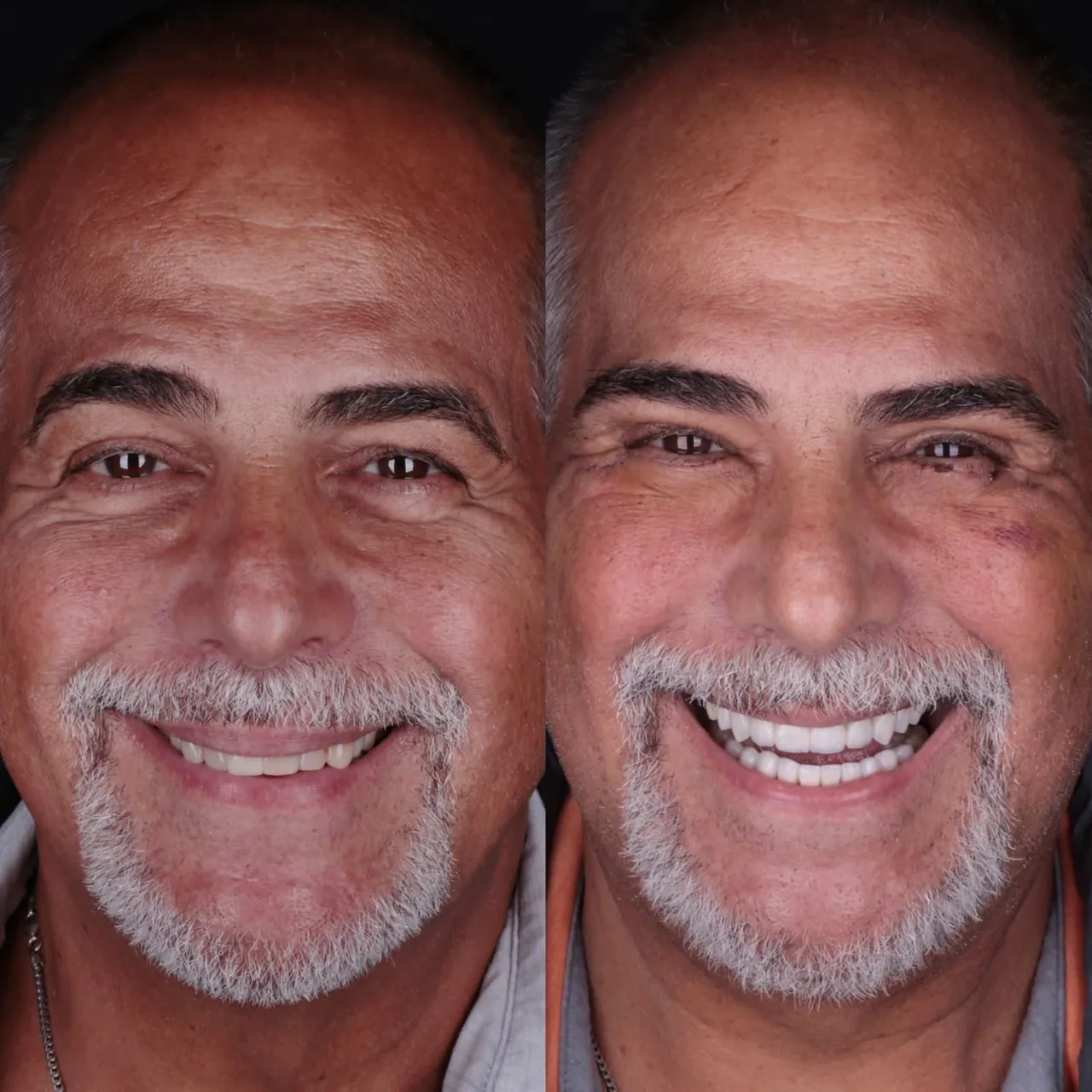 Result of Full-Arch Fixed Prosthesis (Same-Day) at IDF Oral Clinic
